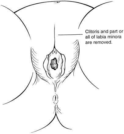 Excision du clitoris, avec excision partielle ou totale des petites lèvres