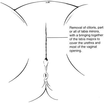 L’excision ne correspond pas à la circoncision du prépuce mais du gland !!!