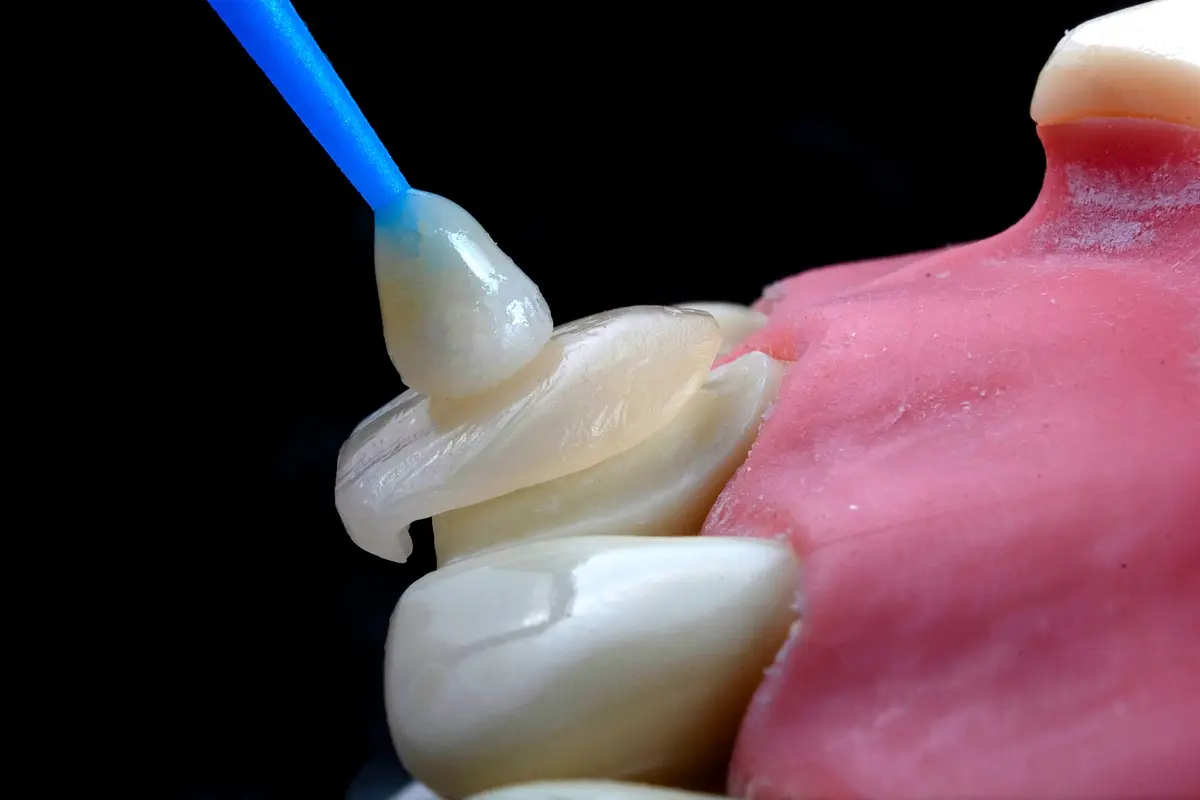Régénération osseuse innovante : solutions révolutionnaires en odontologie